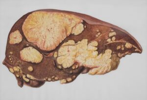 Early Signs and Symptoms That Indicate Potential Liver Damage or Disease