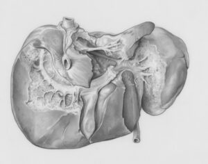 Genetic Liver Diseases What to Know About Inherited Liver Health Disorders